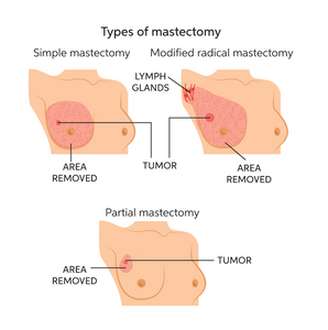 The various types of surgery for breast cancer